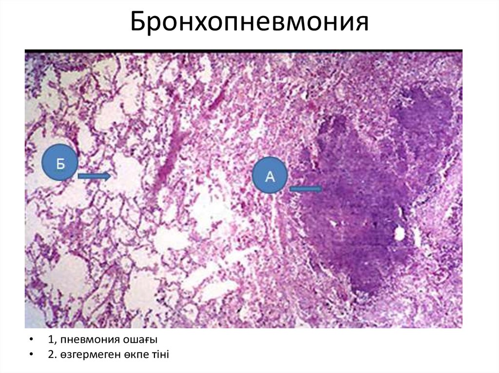 Бронхопневмония карта вызова