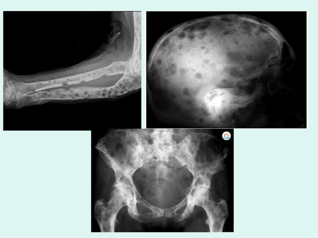 Болезнь рентген. Миеломная болезнь рентген костей. Рентген черепа при миеломной болезни. Кости черепа при миеломной болезни. Множественная миелома рентген черепа.