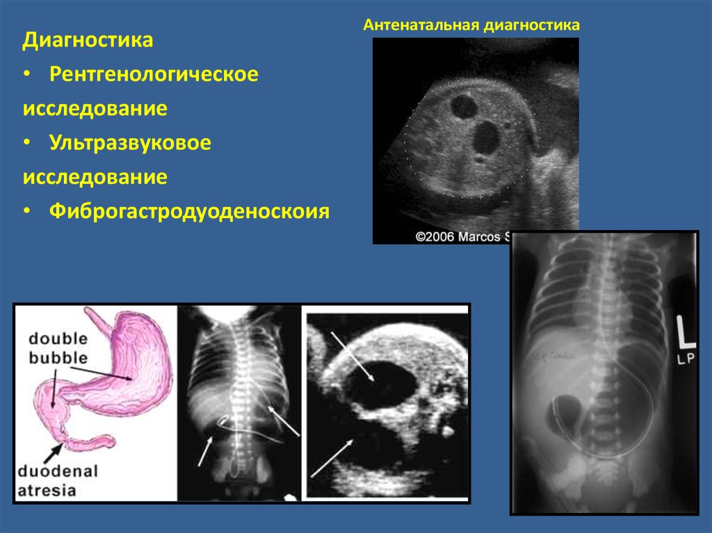 Врожденная низкая кишечная непроходимость презентация