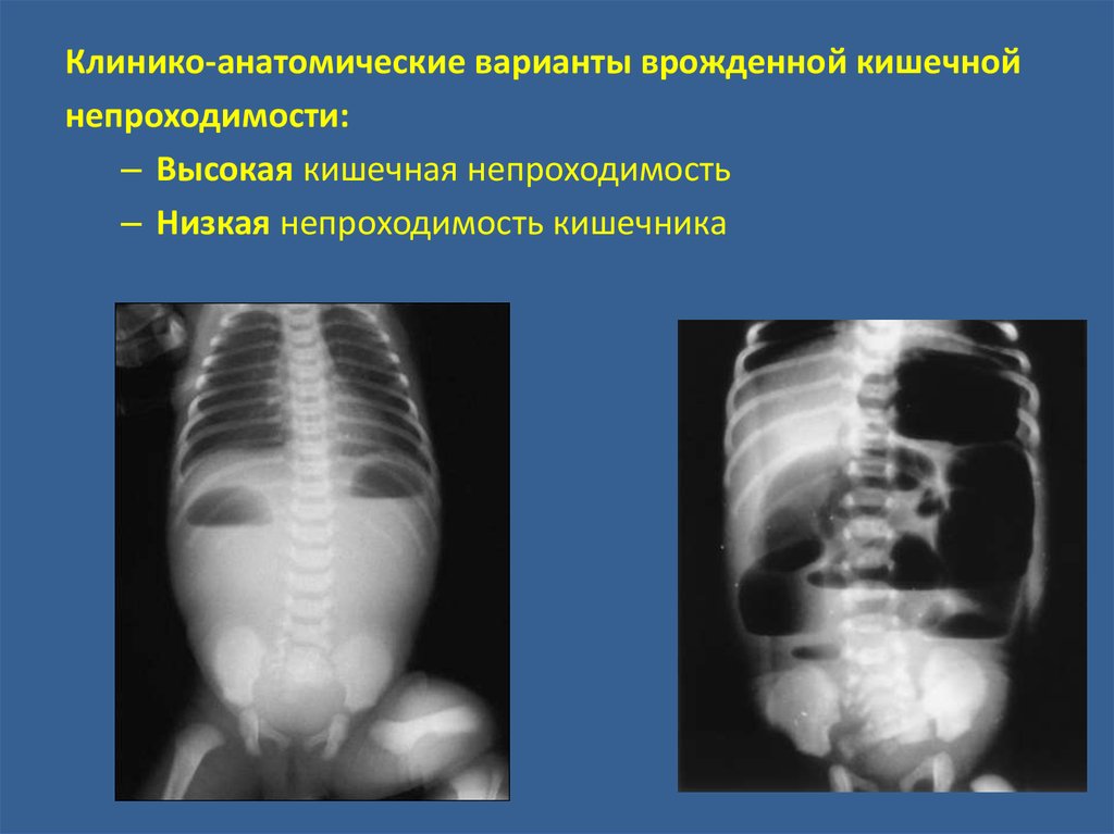 Врожденная низкая кишечная непроходимость презентация