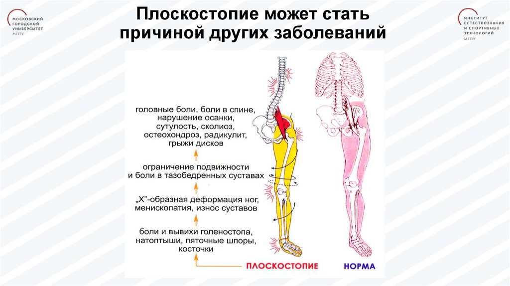 Плоскостопие мкб. Патогенез плоскостопия. Мышца отвечающая за плоскостопие. Плоскостопие и остеохондроз. Влияние плоскостопия на позвоночник.