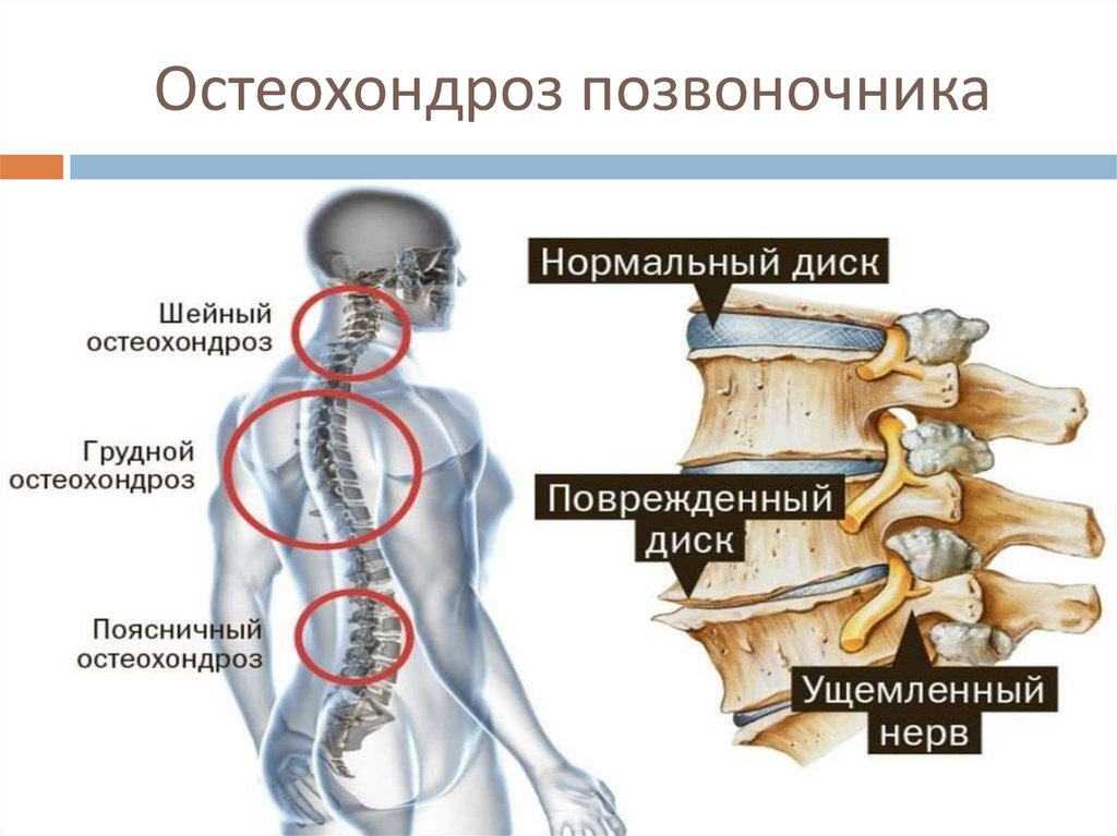 Клиническая картина метастатического поражения позвоночника отличается от остеохондроза