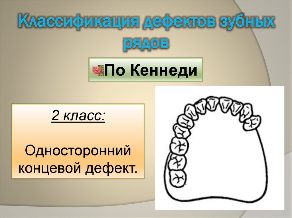 Включи конечную. Дефект зубного ряда 1 класс по Кеннеди. Классификация по Кеннеди ортопедия. Концевые дефекты зубных рядов по Кеннеди. Классификация дефектов зубных рядов.