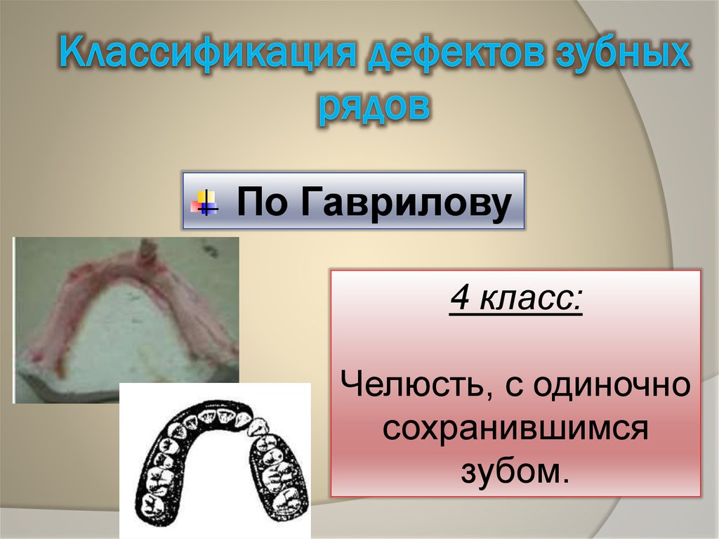 Дефекты зубных рядов. Классификация по Гаврилову. Классификация дефектов по Гаврилову. Классификация частичной потери зубов по Гаврилову. Дефекты зубов по Гаврилову.