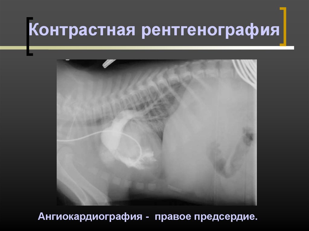 Рентгеноскопия контрастное вещество. Контрастная рентгенография. Контрастная рентгеноскопия. Контрастная ренография это. Контрастнаяренггенография.