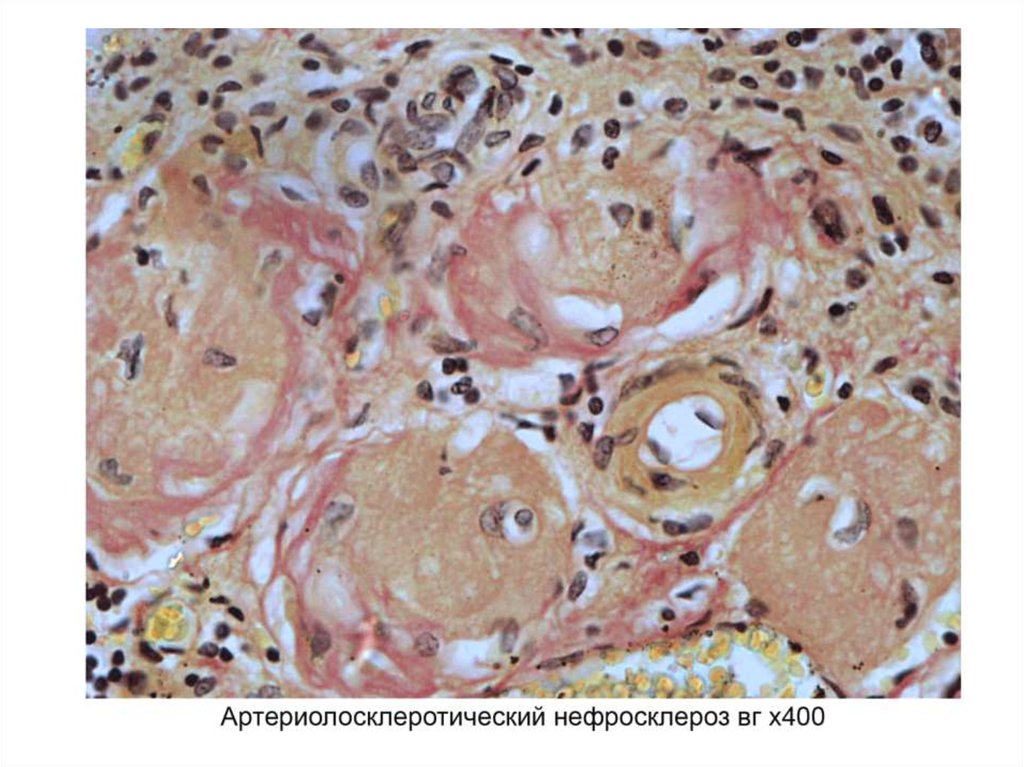 Артериолосклеротический нефросклероз микропрепарат рисунок