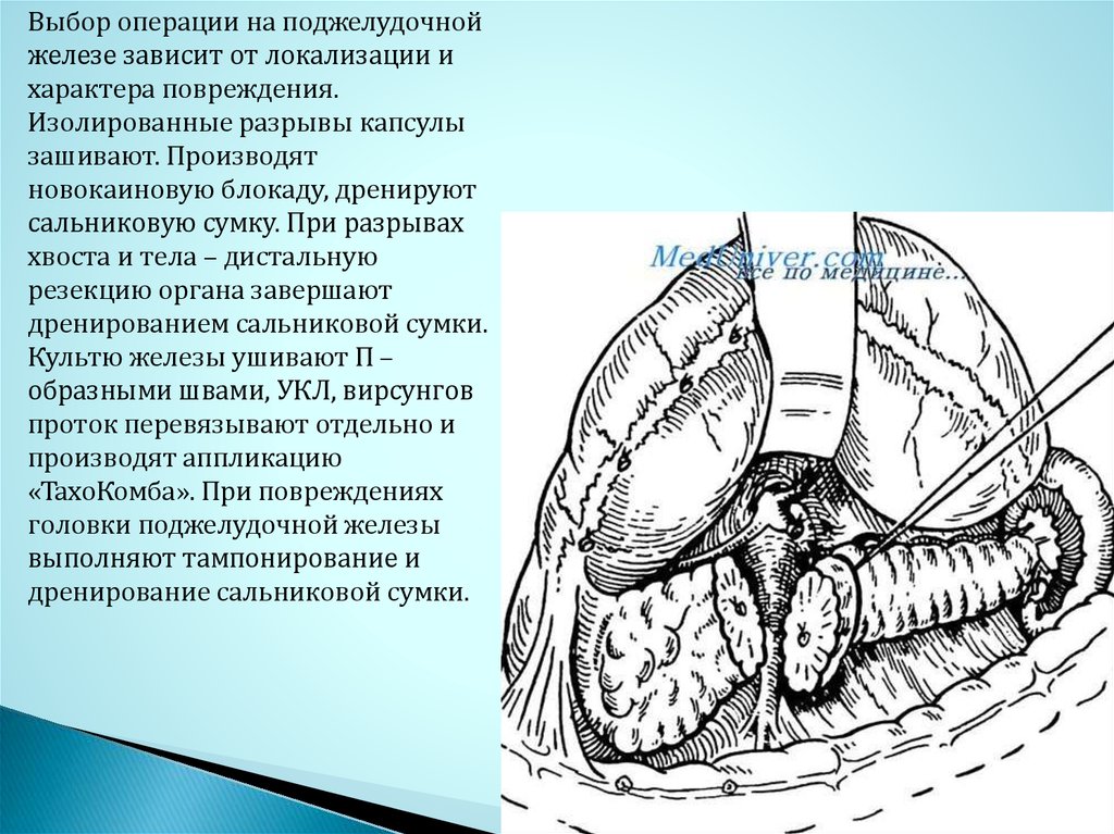 Повреждение поджелудочной железы презентация