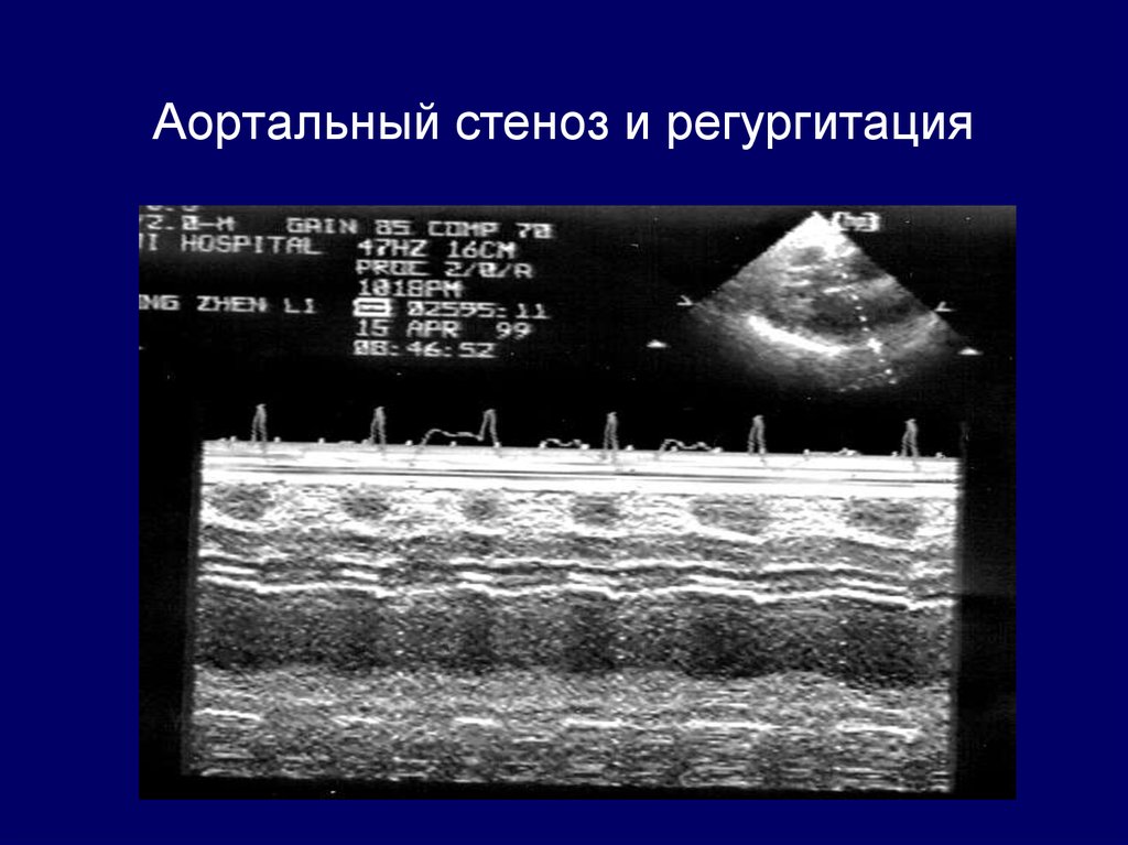 Минимальная аортальная регургитация. ЭХОКГ при приобретенных пороках сердца.