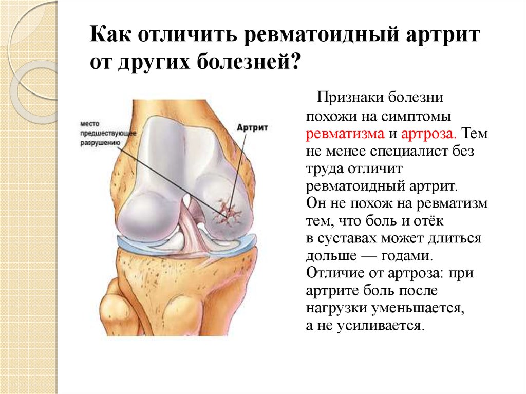 Ревматоидный артрит презентация