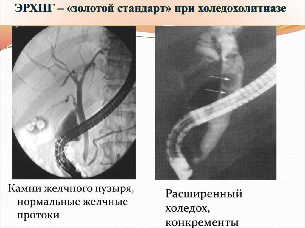 Лучевая диагностика желчевыводящих путей презентация