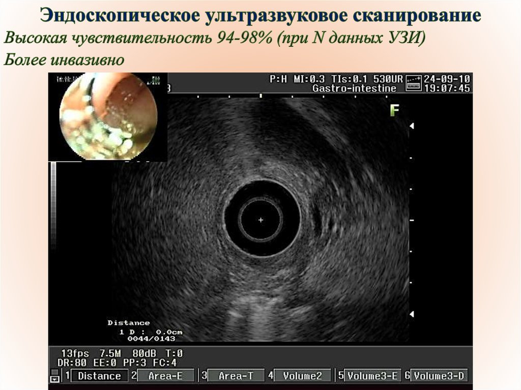 Эндоузи. Эндоскопическое ультразвуковое исследование желчного пузыря. ЭНДОУЗИ желчного пузыря. Эндоскопическое ультразвуковое исследование (ЭУЗИ).