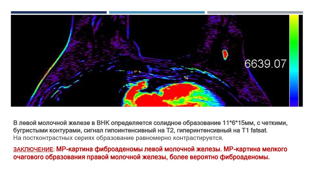 Неспецифический рак молочной железы g3