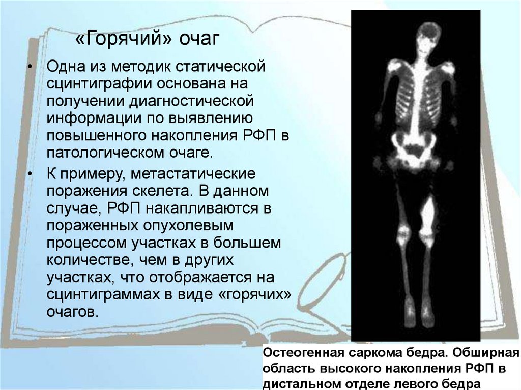 Метастатическое поражение костей. Метастатическое поражение костей скелета. Сцинтиграфия костей скелета (остеосцинтиграфия). Сцинтиграфия костей скелета норма. Горячие и холодные очаги сцинтиграфия костей.