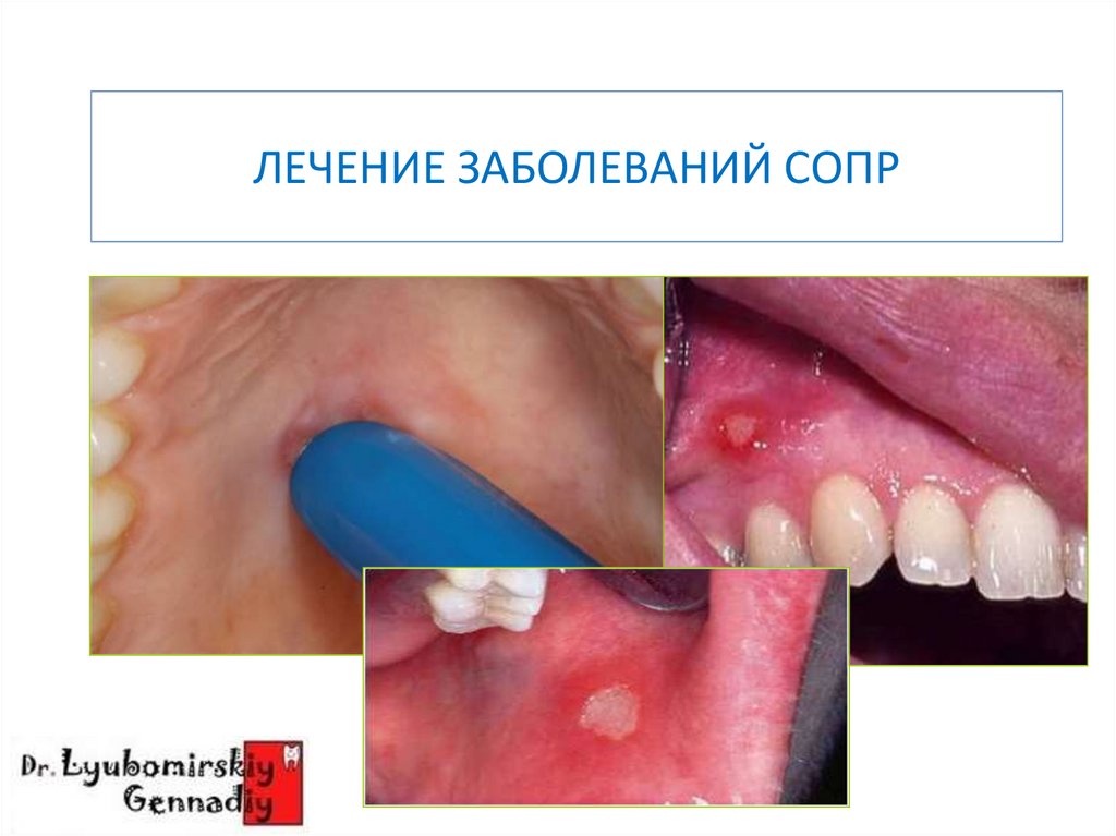 ЛЕЧЕНИЕ ЗАБОЛЕВАНИЙ СОПР