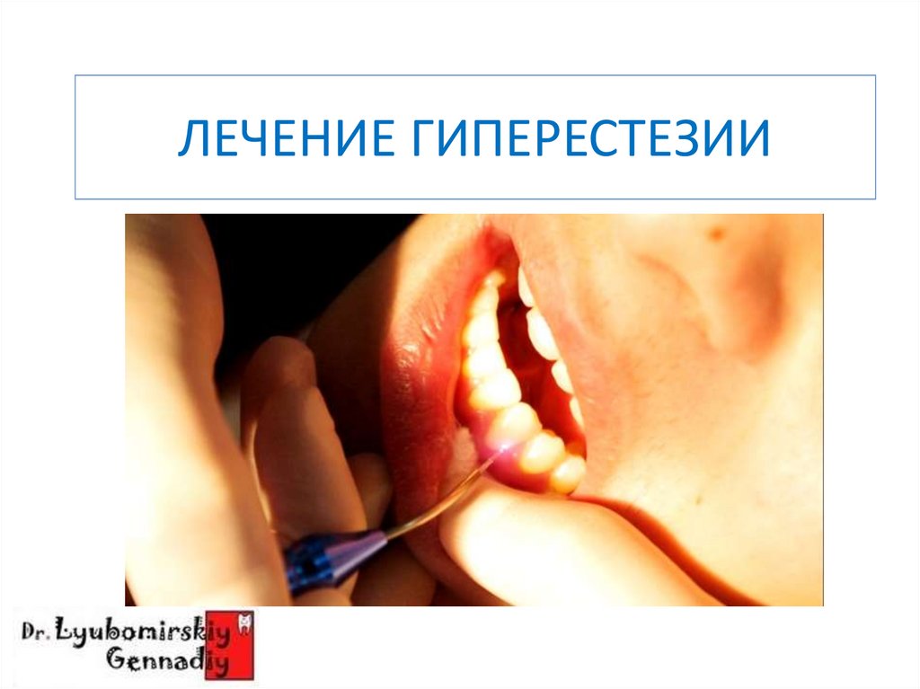 ЛЕЧЕНИЕ ГИПЕРЕСТЕЗИИ