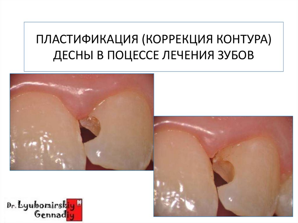ПЛАСТИФИКАЦИЯ (КОРРЕКЦИЯ КОНТУРА) ДЕСНЫ В ПОЦЕССЕ ЛЕЧЕНИЯ ЗУБОВ