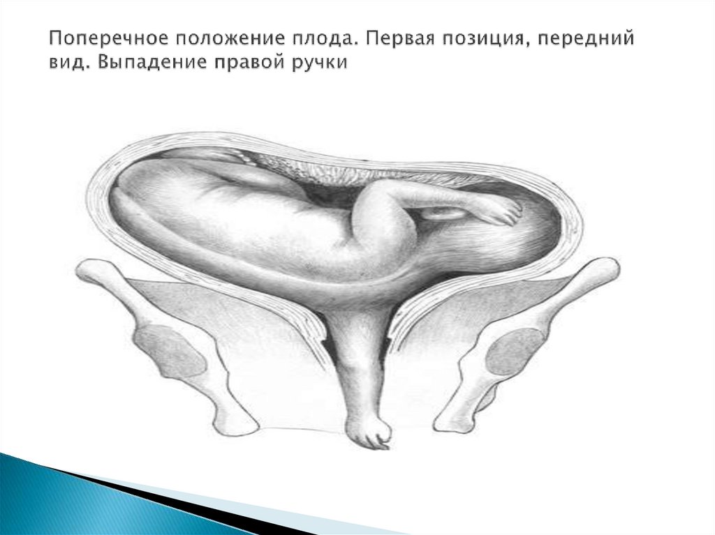 Косое и поперечное положение плода презентация