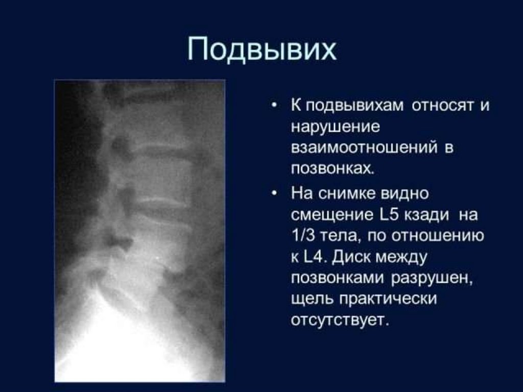 Подвывих. Подвывих поясничного позвонка на рентгене. Подвывих с1 шейного позвонка рентген. Вывих шейного позвонка рентген. Подвывих шейного позвонка рентген.