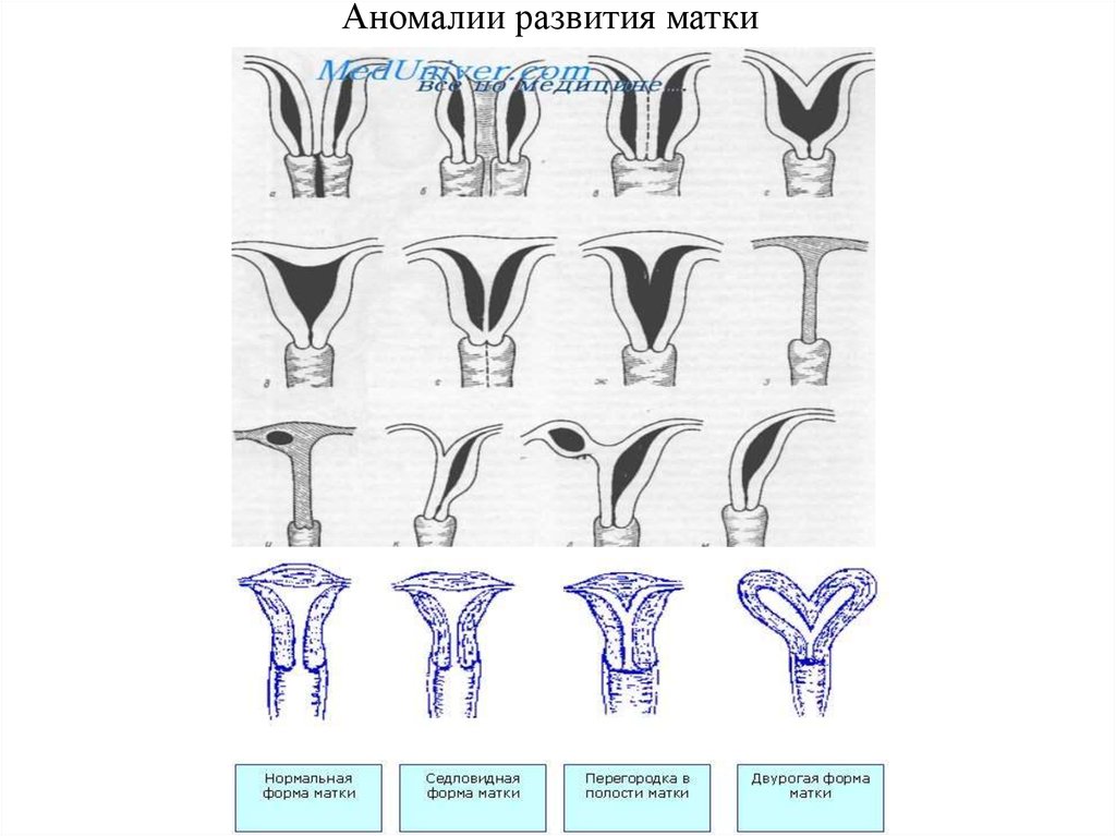 Форма матки. Пороки развития матки классификация. Аномалия развития матки двурогая матка. Аномалия развития матки седловидная. Аномалии развития матки классификация.