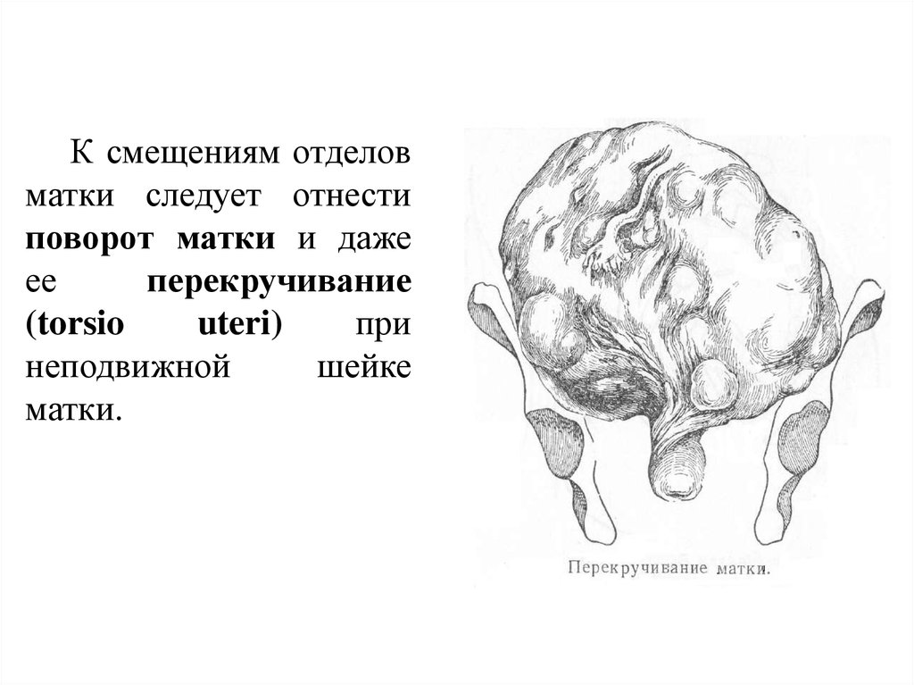 Полная матка. Поворот матки. Неправильное положение яичников.