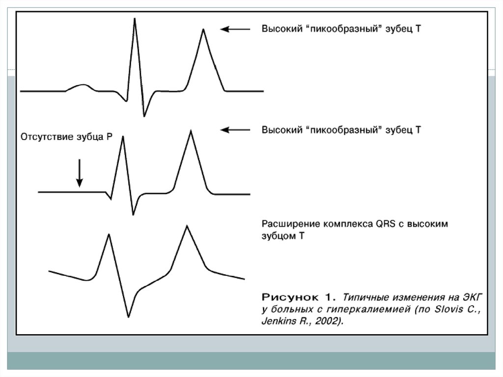 Высокий т на экг причины. Гиперкалиемия симптомы ЭКГ. Симптомы гиперкалиемии на ЭКГ. Изменения на ЭКГ при гиперкалиемии. Признаки гиперкалиемии на ЭКГ.