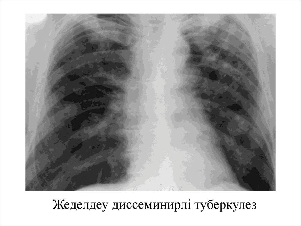 Острый диссеминированный туберкулез. Подострый диссеминированный туберкулез рентген. Острый диссеминированный туберкулез рентген. Хронический диссеминированный туберкулез рентген. Подострый диссеминированный туберкулез рентгенограмма.