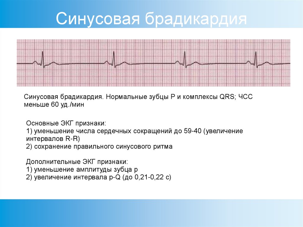 Синусовая брадикардия. Синусовая брадикардия на ЭКГ. Пароксизмальная брадикардия ЭКГ. ЭКГ критерии синусовой брадикардии. Изменения ЭКГ, характерные для синусовой брадикардии:.