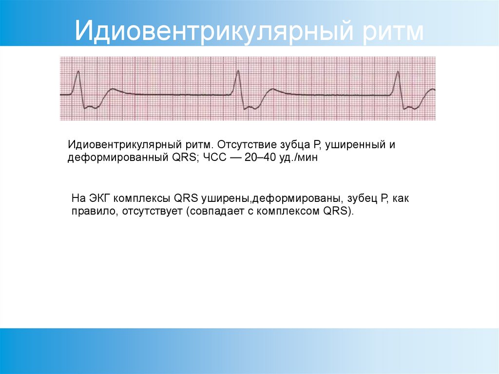 Желудочковый ритм. Идиовентрикулярный желудочковый ритм. Идиовентрикулярный желудочковый ритм ускоренный. Ускоренный идиовентрикулярный ритм на ЭКГ. Ускоренный желудочковый ритм на ЭКГ.