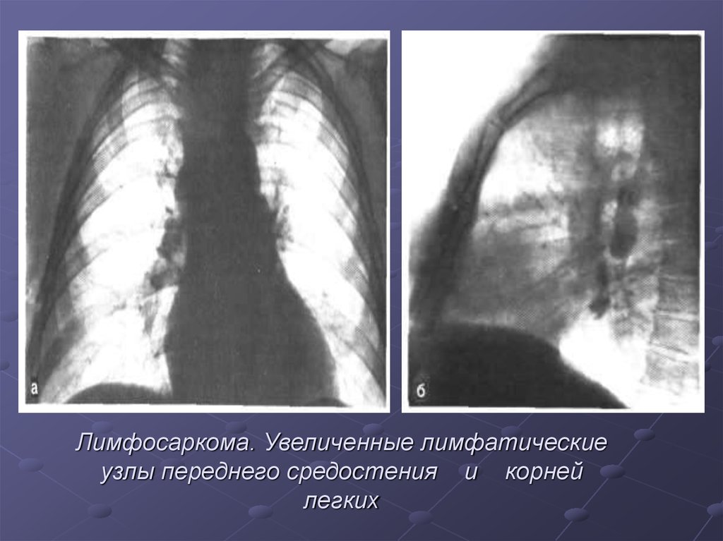 Рак средостения фото