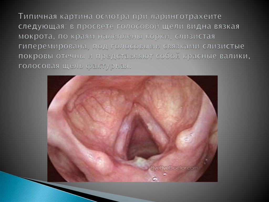 Типичная картина осмотра при ларинготрахеите следующая: в просвете голосовой щели видна вязкая мокрота, по краям налеплены