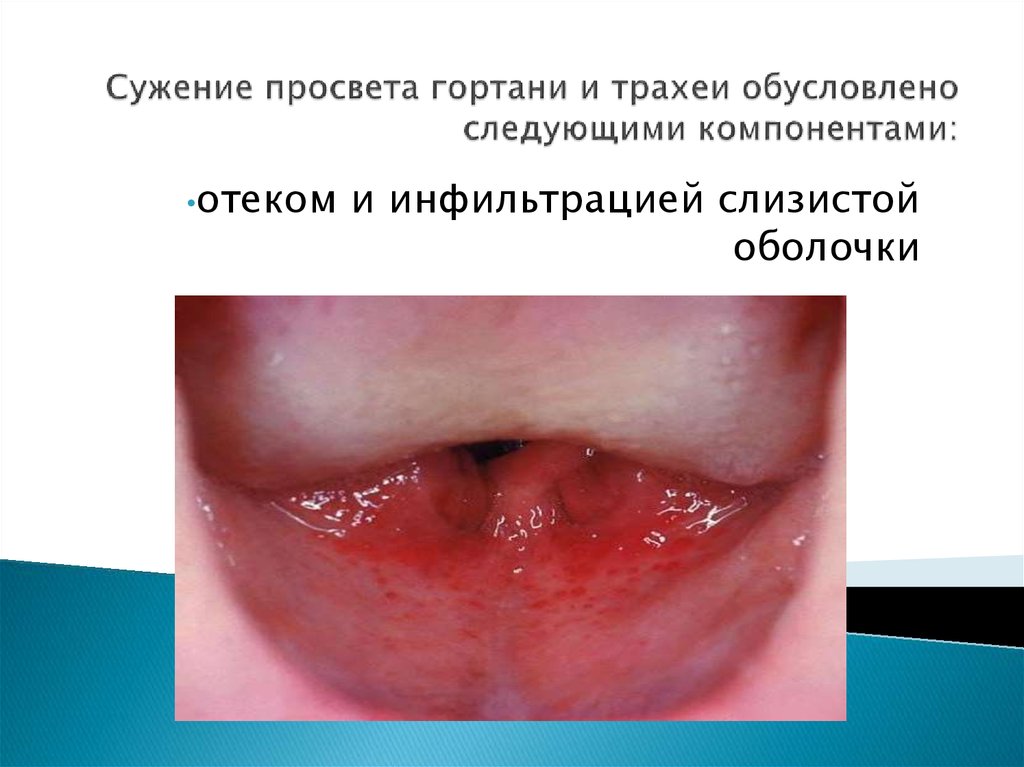 Сужение просвета гортани и трахеи обусловлено следующими компонентами: