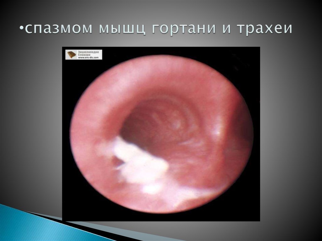 спазмом мышц гортани и трахеи