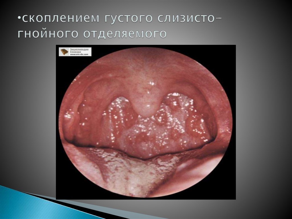 скоплением густого слизисто-гнойного отделяемого