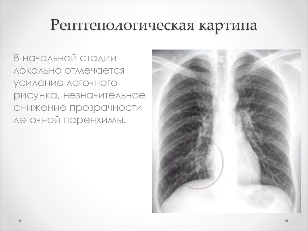 Абструкция легких. Острый обструктивный бронхит рентген. Обструктивный бронхит рентгенограмма. Обструктивный бронхит рентген. Рентген признаки ХОБЛ.