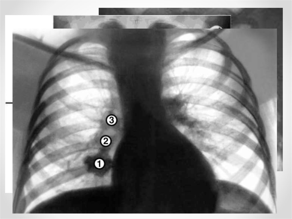 Узелки в легких. Рентгенограмма грудной клетки туберкулез. Рентген снимок при туберкулезе внутригрудных лимфатических узлов. Лимфоузлы средостения рентген. Первичный туберкулезный комплекс на рентгенограмме.