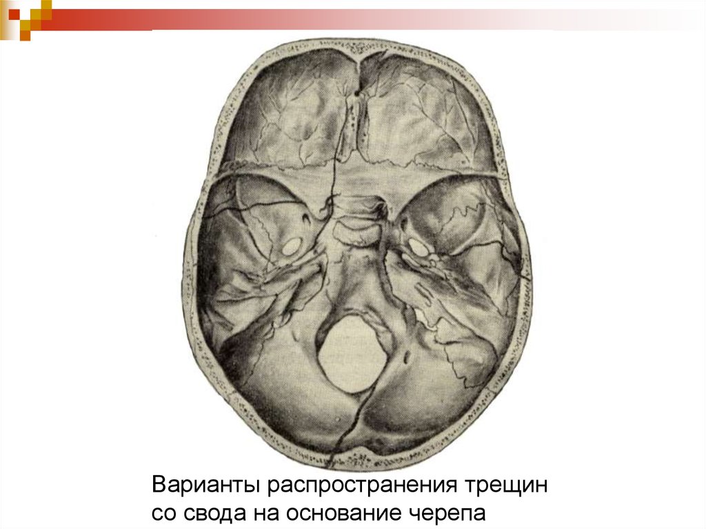 Свод и основание черепа. Травматические повреждения черепа и головного мозга.. Область свода и основания черепа. Сквозная трещина основания черепа. Валик под основание черепа.