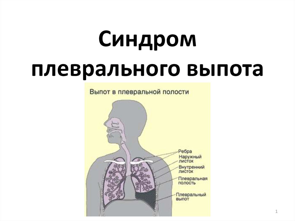 Синдром жидкости в плевральной полости презентация thumbnail