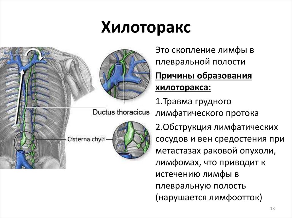 Полость причина. Хилоторакс грудной проток. Лимфатические протоки грудной полости. Травма грудного лимфатического протока. Левосторонний хилоторакс.