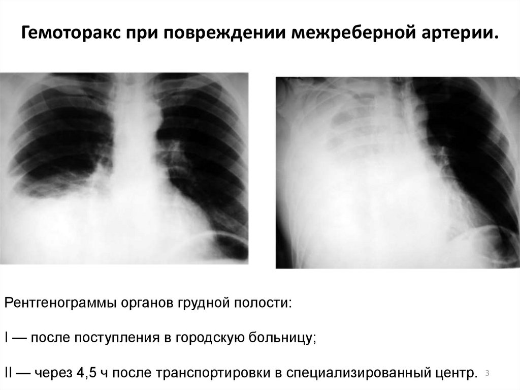 Плевральный выпот причины