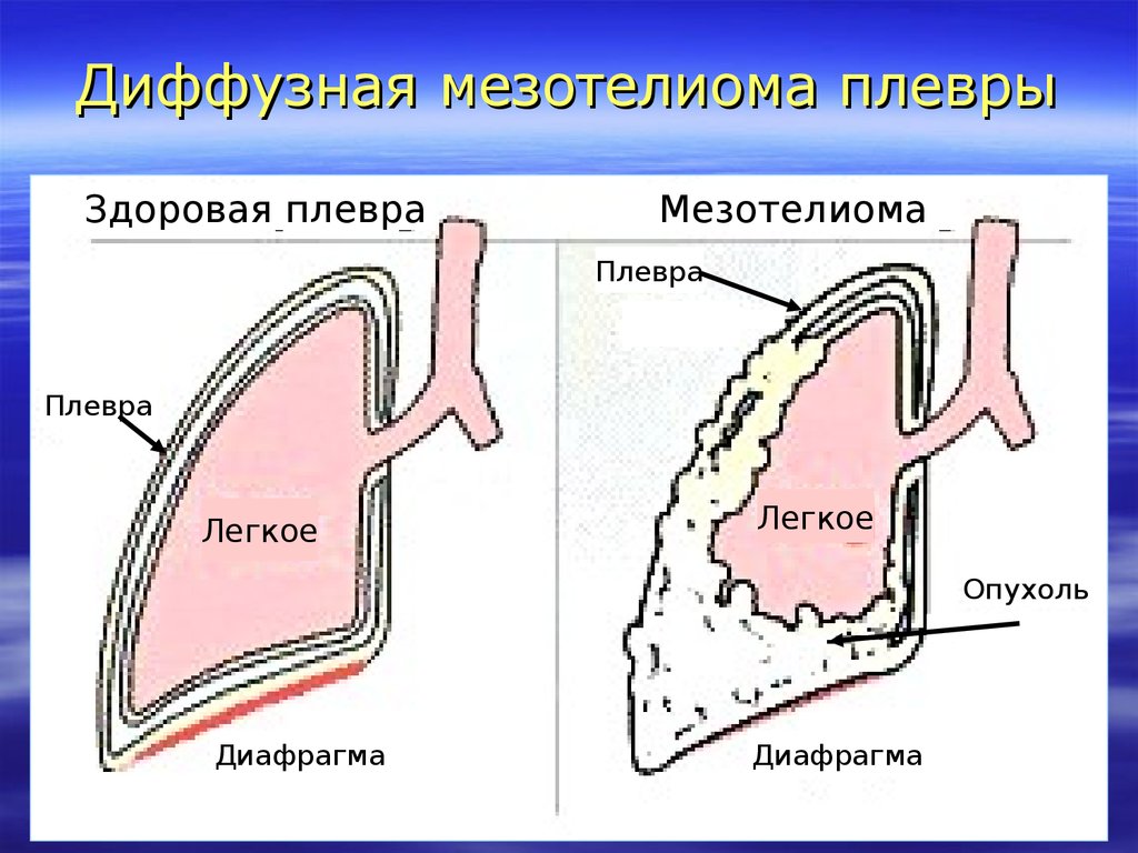 Мезотелиома плевры кт картина