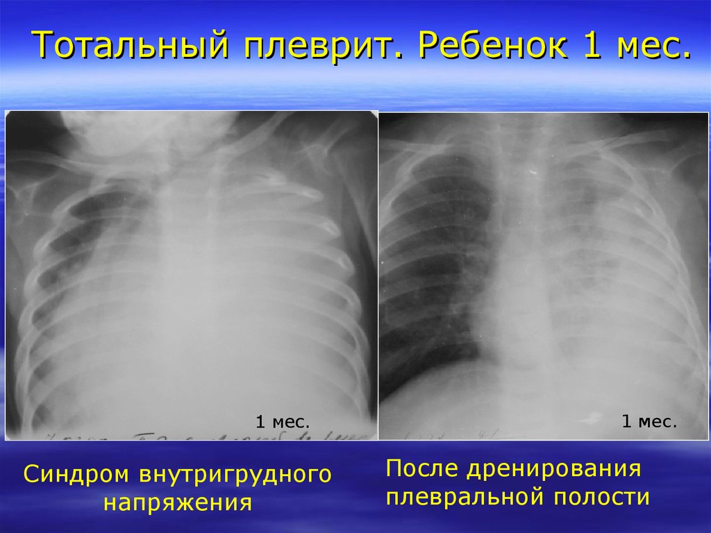 Что такое плеврит легких. Адгезивный плеврит рентген.