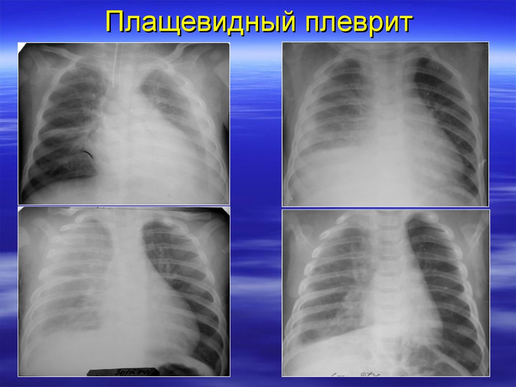 Сухой плеврит рентгенологическая картина