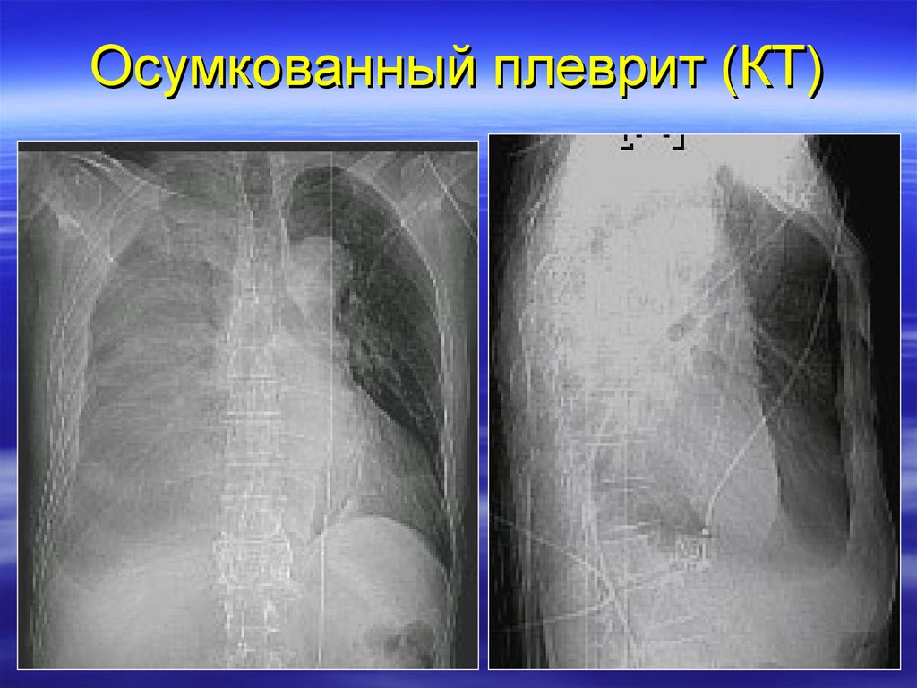 Плеврит карта вызова