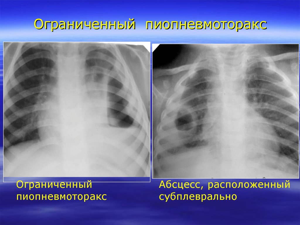 На рентгенологической картине напряженного пиопневмоторакса отмечается смещение средостения в