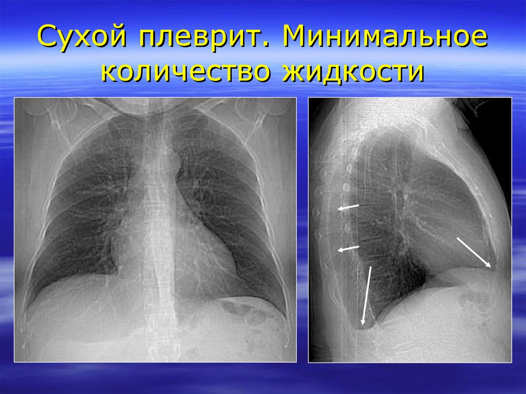 Сухой плеврит рентгенологическая картина