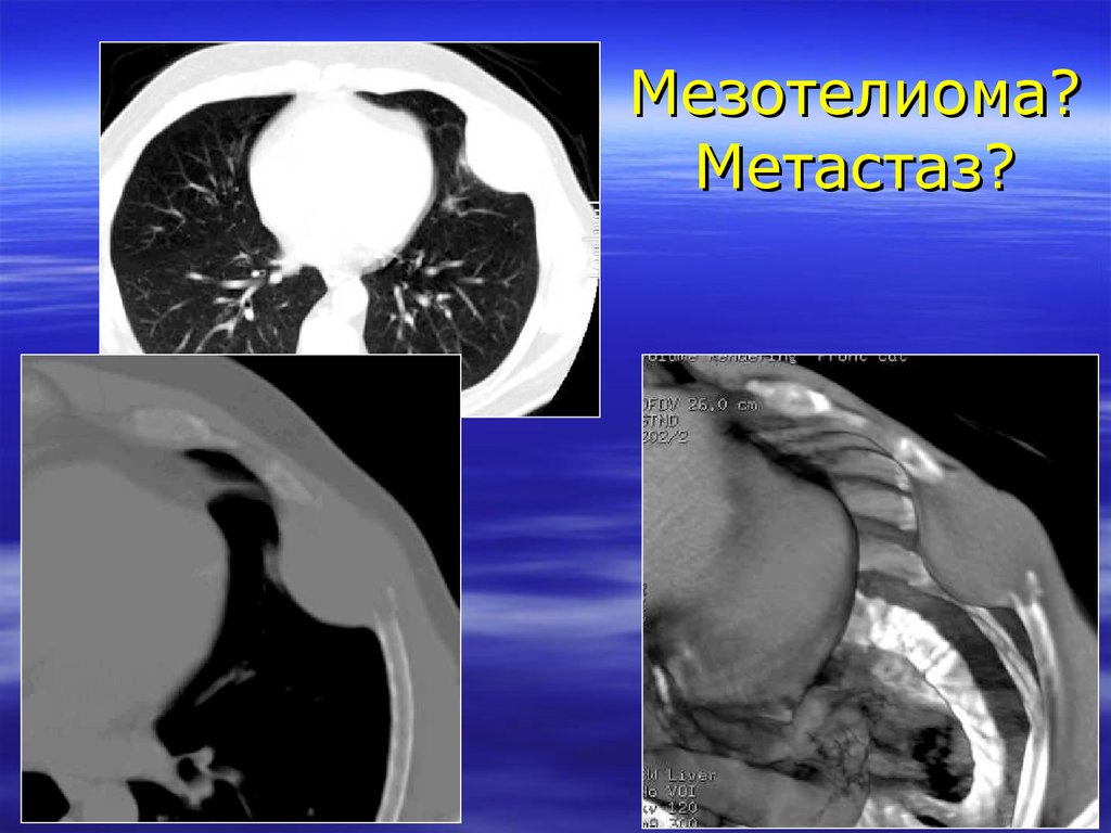 Мезотелиома плевры кт картина