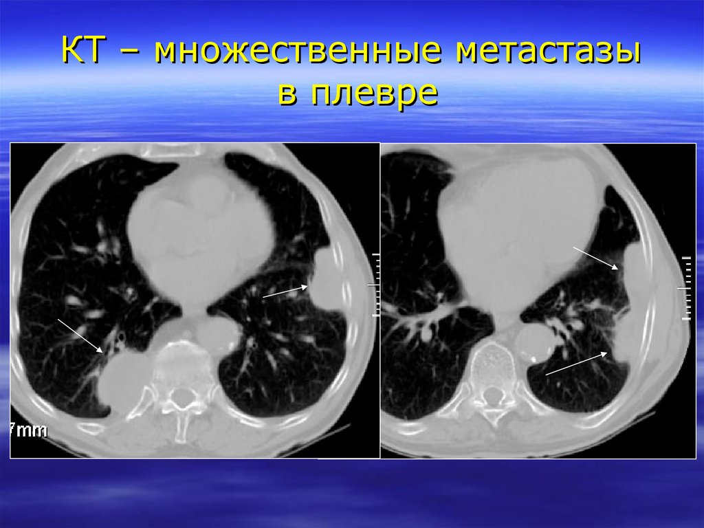 Мезотелиома плевры кт картина