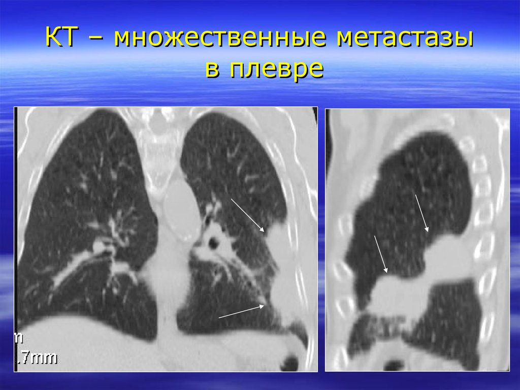 Метастазы в легких продолжительность жизни