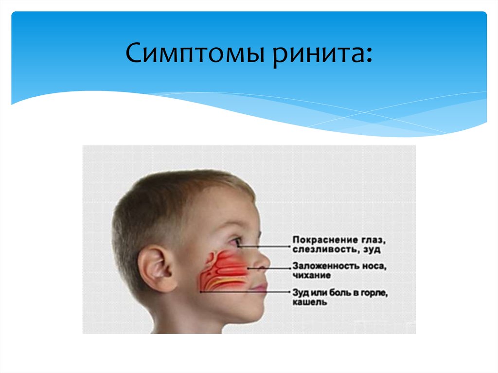 Признаки заложенности носа. Симптомы острого ринита.