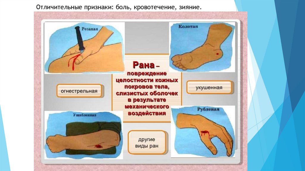Отличительные признаки: боль, кровотечение, зияние.